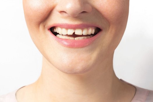 A woman with a broken tooth near Westlake