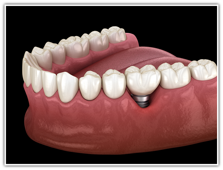 Illustration of dental implant in lower arch