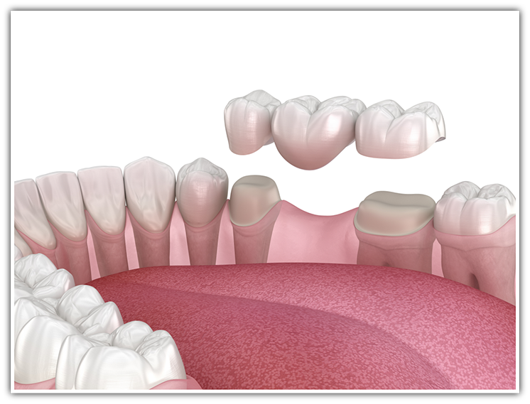 Illustration of dental bridge being placed to replace a tooth