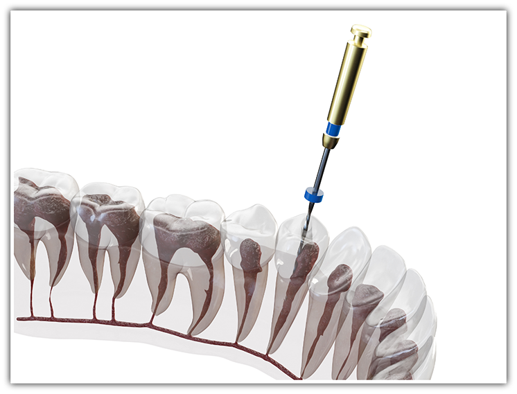 Illustration of root canal treatment for lower arch
