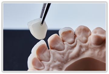 Attaching veneer to impression of teeth