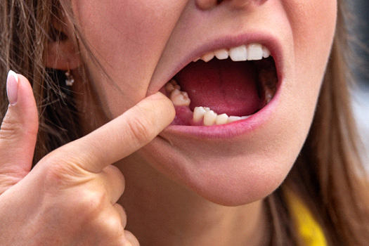 Woman missing a tooth