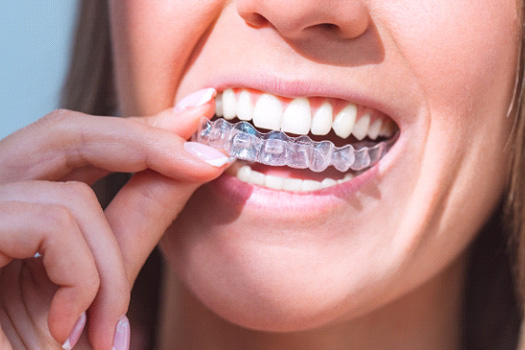 Woman putting in clear aligners
