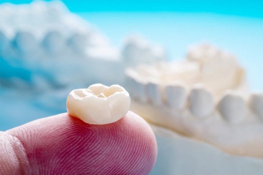 A tooth-colored crown resting on a dentist’s fingertip