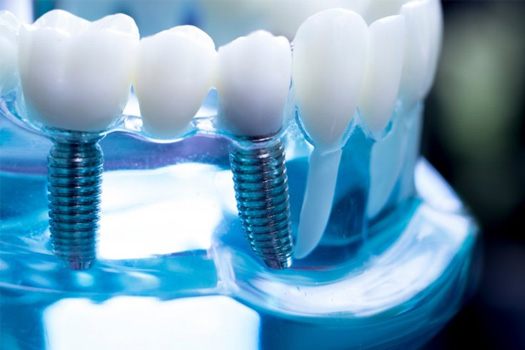 Model of a dental bridge with two implant posts