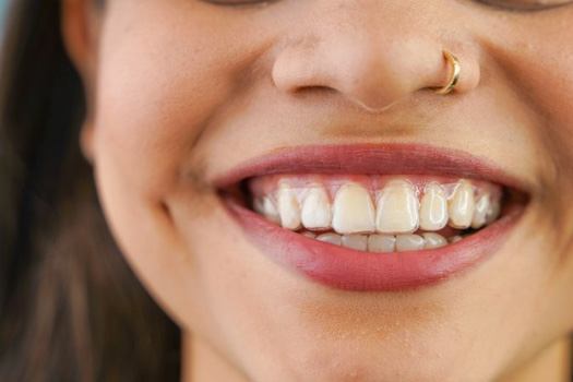 Patient smiling with a clear aligner on her upper teeth