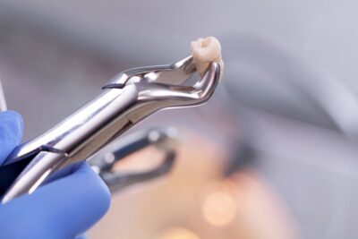 Extracted tooth in pliers.