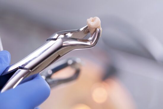 Extracted tooth in pliers.