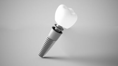 A single dental implant.
