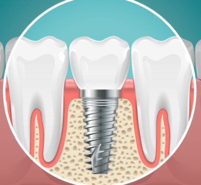 Illustrated cross section of a dental implant.