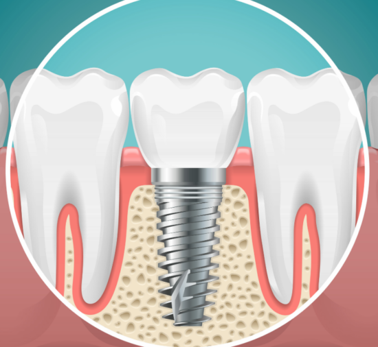 Illustrated cross section of a dental implant.