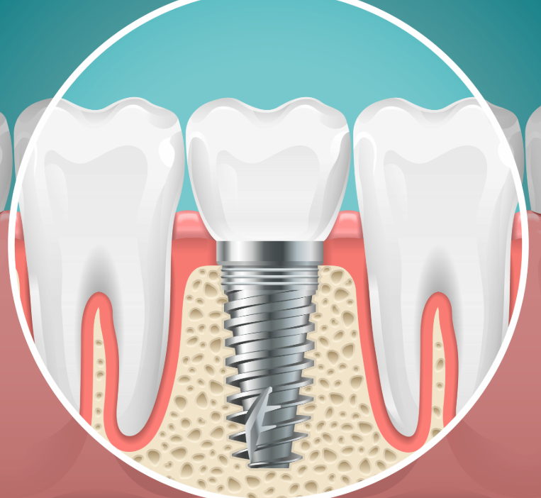 Illustrated cross section of a dental implant